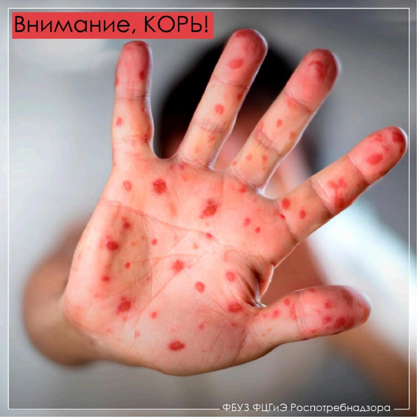 ВНИМАНИЕ Корь