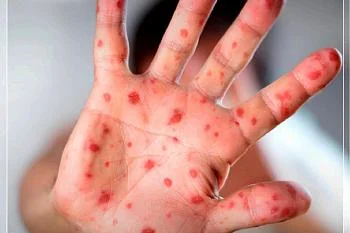 ВНИМАНИЕ Корь